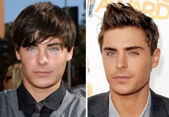 Zac Efron Plastic Surgery Before and After
