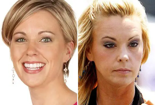 Kate Gosselin Plastic Surgery Before and After