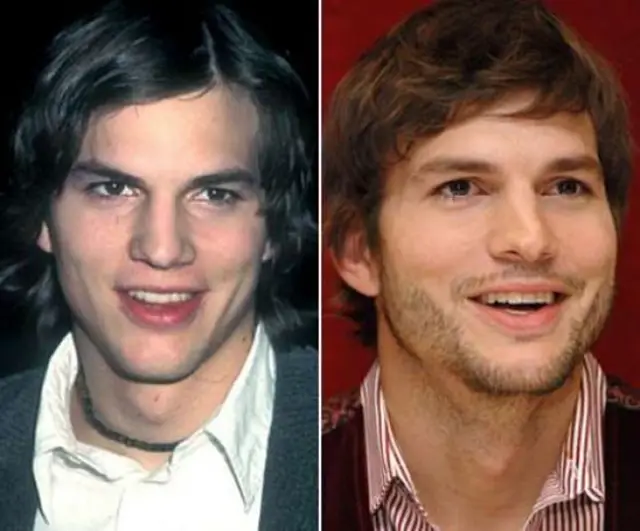 Ashton Kutcher Nose Job Plastic Surgery Before and After | Celebie