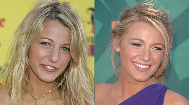 Blake Lively Breast Implants & Nose Job Plastic Surgery