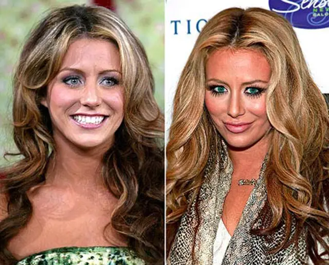 Aubrey O’Day Lip Augmentation Plastic Surgery Before and
