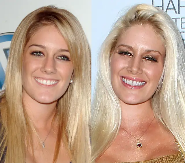 Heidi Montag Nose Job Plastic Surgery Before and After Celebie