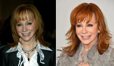 Reba McEntire Facelift Plastic Surgery Before and After | Celebie