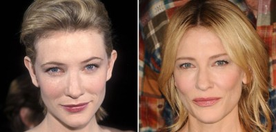 Cate Blanchett Facelift Plastic Surgery Before and After | Celebie