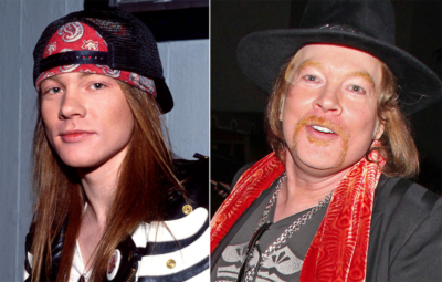 Axl Rose Plastic Surgery Before and After | Celebie